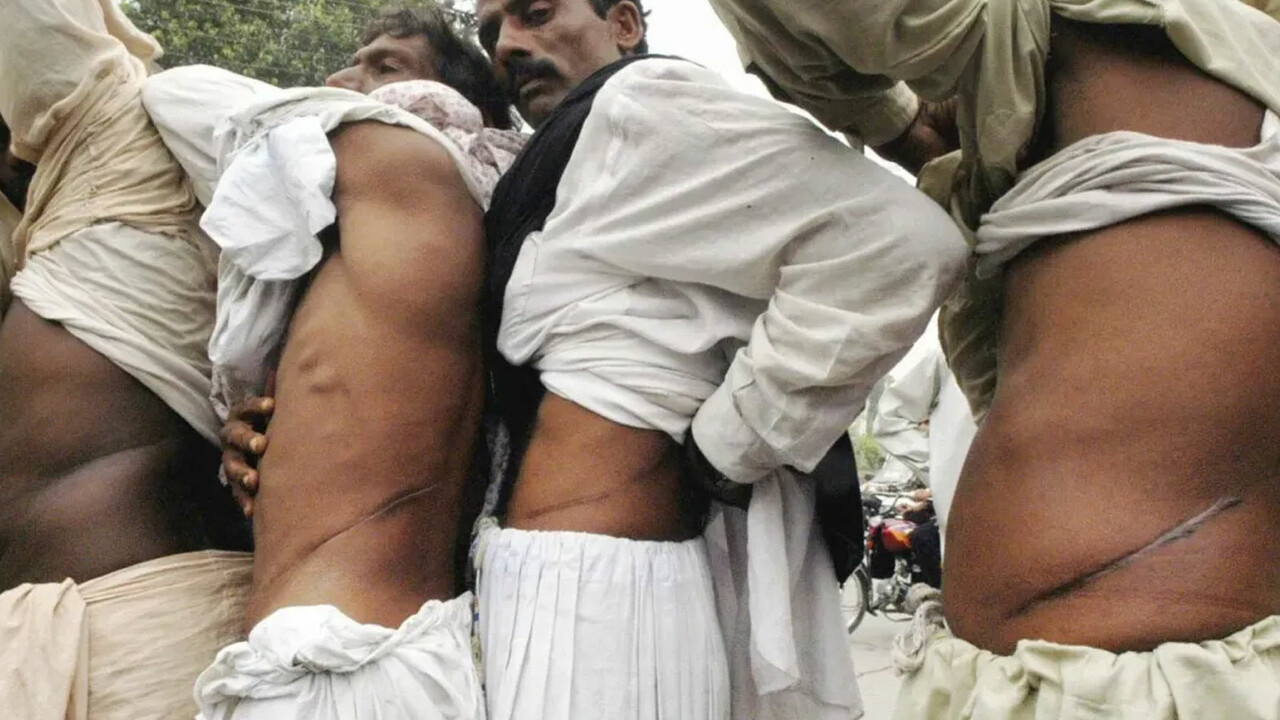 Pakistan'da organ kaçakçılığı şebekesi çökertildi: Araba tamircisinin girdiği ameliyatlarda 300'den fazla kişinin böbreği çalındı görseli