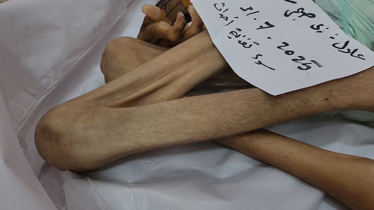 Bu acıya yürek dayanmaz... Görenlerin içini sızlattı! 27 yaşında açlıktan 15 kiloya düştü