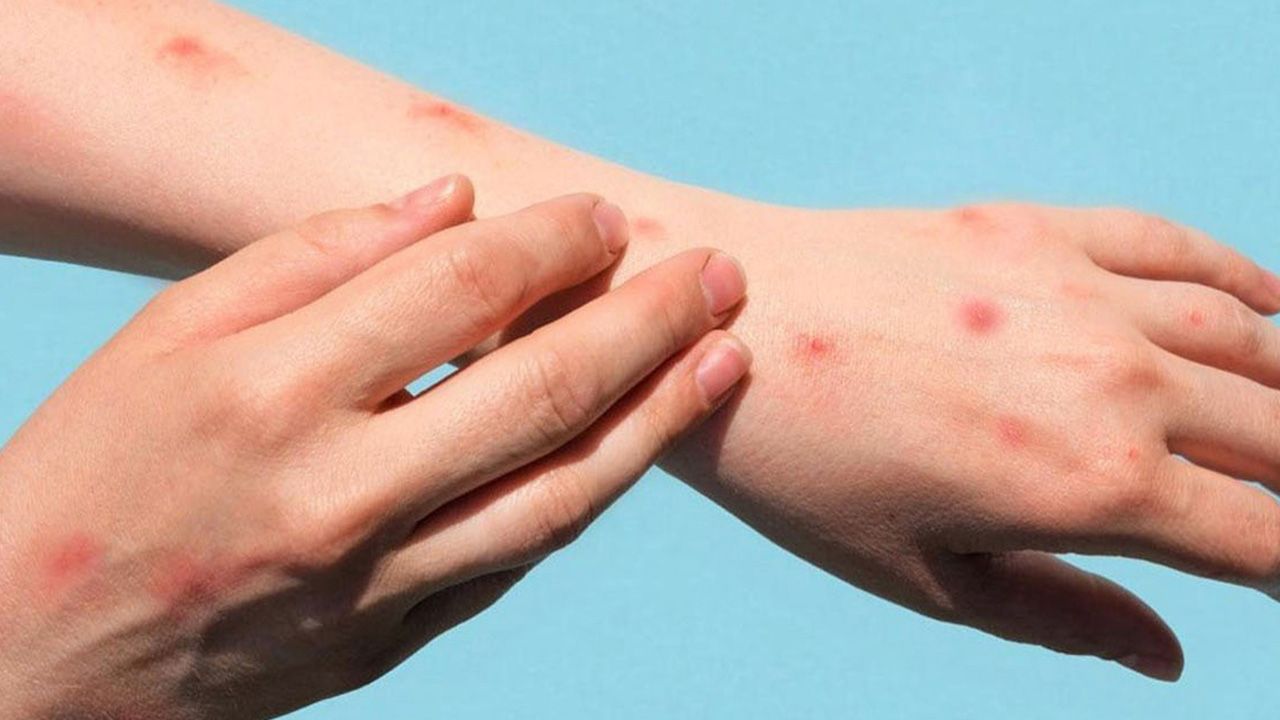 Mpox tehlikesi büyüyor! Vaka sayısı 300