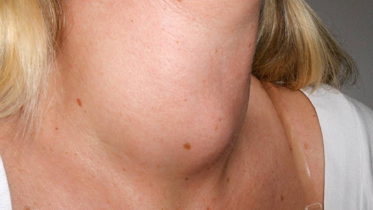 Boynunuzda şişlik varsa dikkat! O belirtiyi hafife almayın ve doktora koşun...