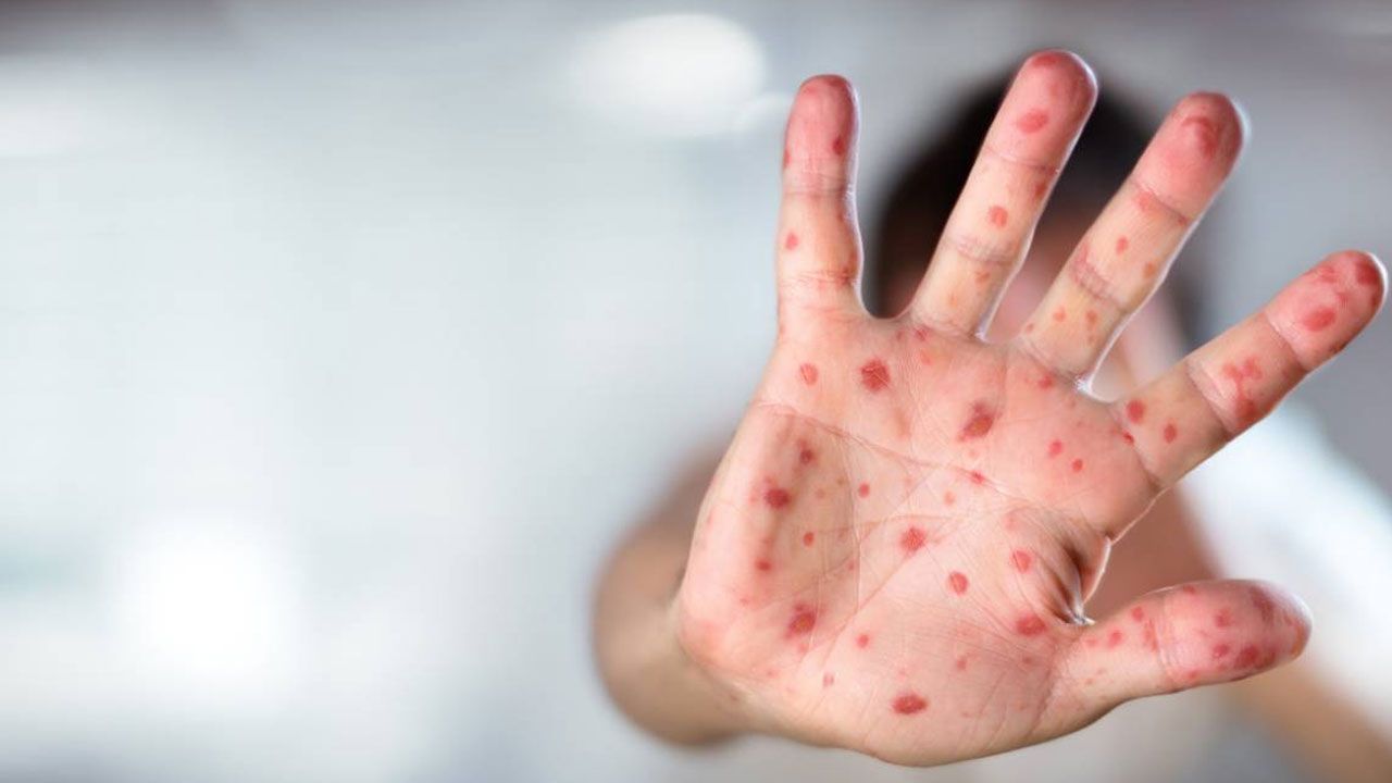 Çocuklarda yaz hastalıkları artıyor! Döküntü ve pullanmaya özellikle dikkat