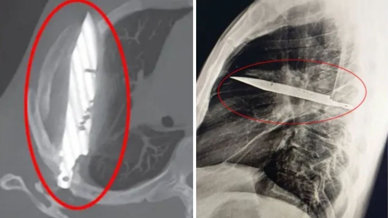 Göğüs ağrısı şikayetiyle gitmişti! Gerçek hastanede ortaya çıktı: Meğer 8 yıldır...