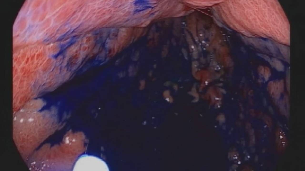 Boyama yöntemi ile mide ve bağırsak kanserinde erken teşhis...