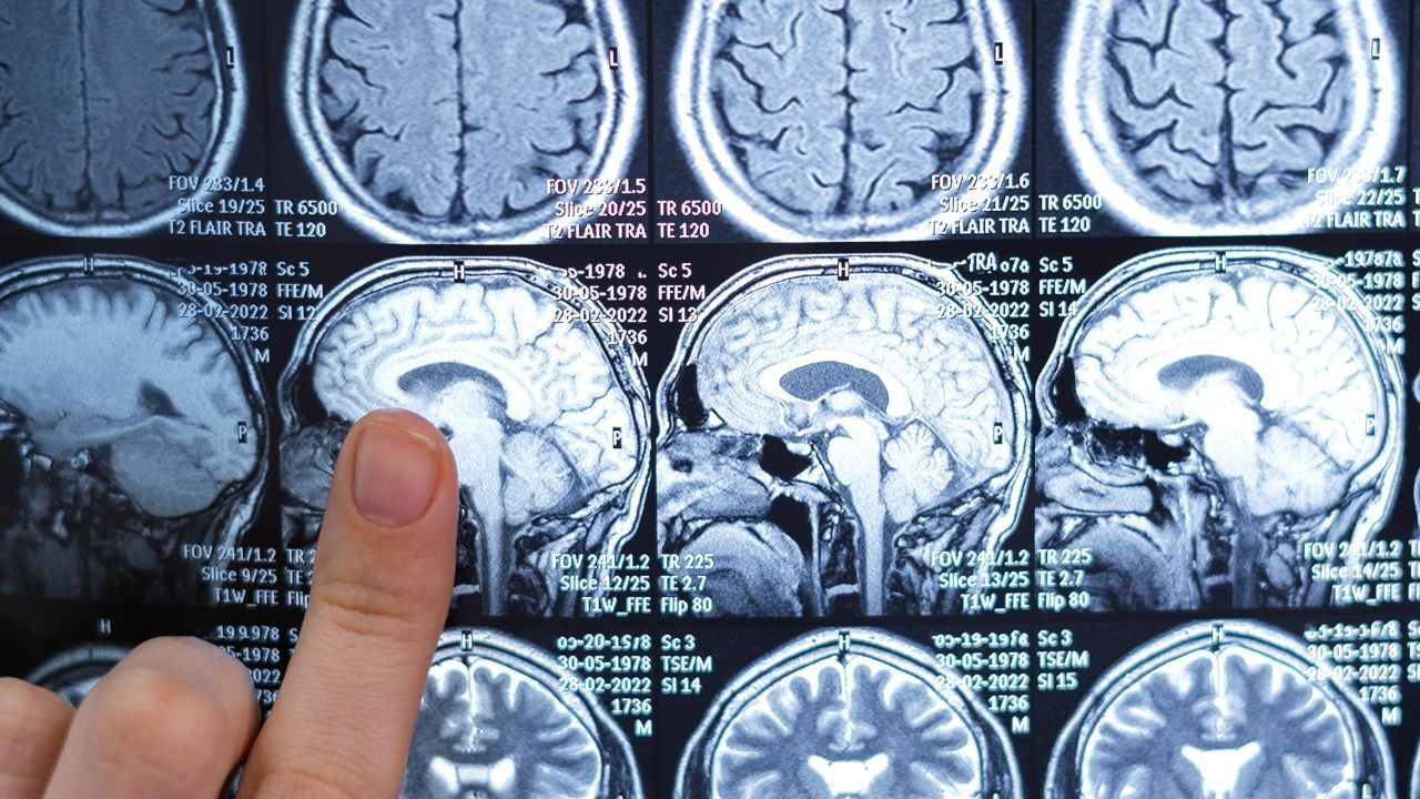 Bilim insanları beyin kanserinin sırrını çözdü!