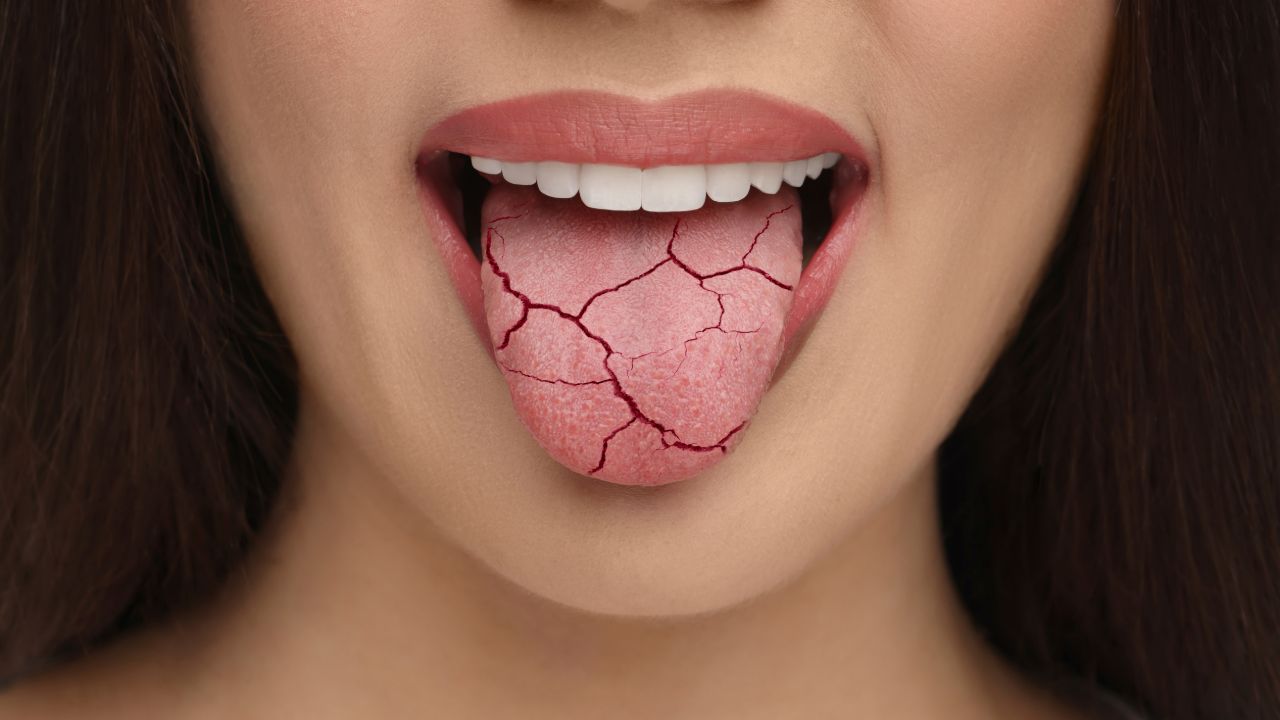 Dil çatlağı vitamin eksikliğinin belirtisi! 10 kişiden ikisinde görülüyor