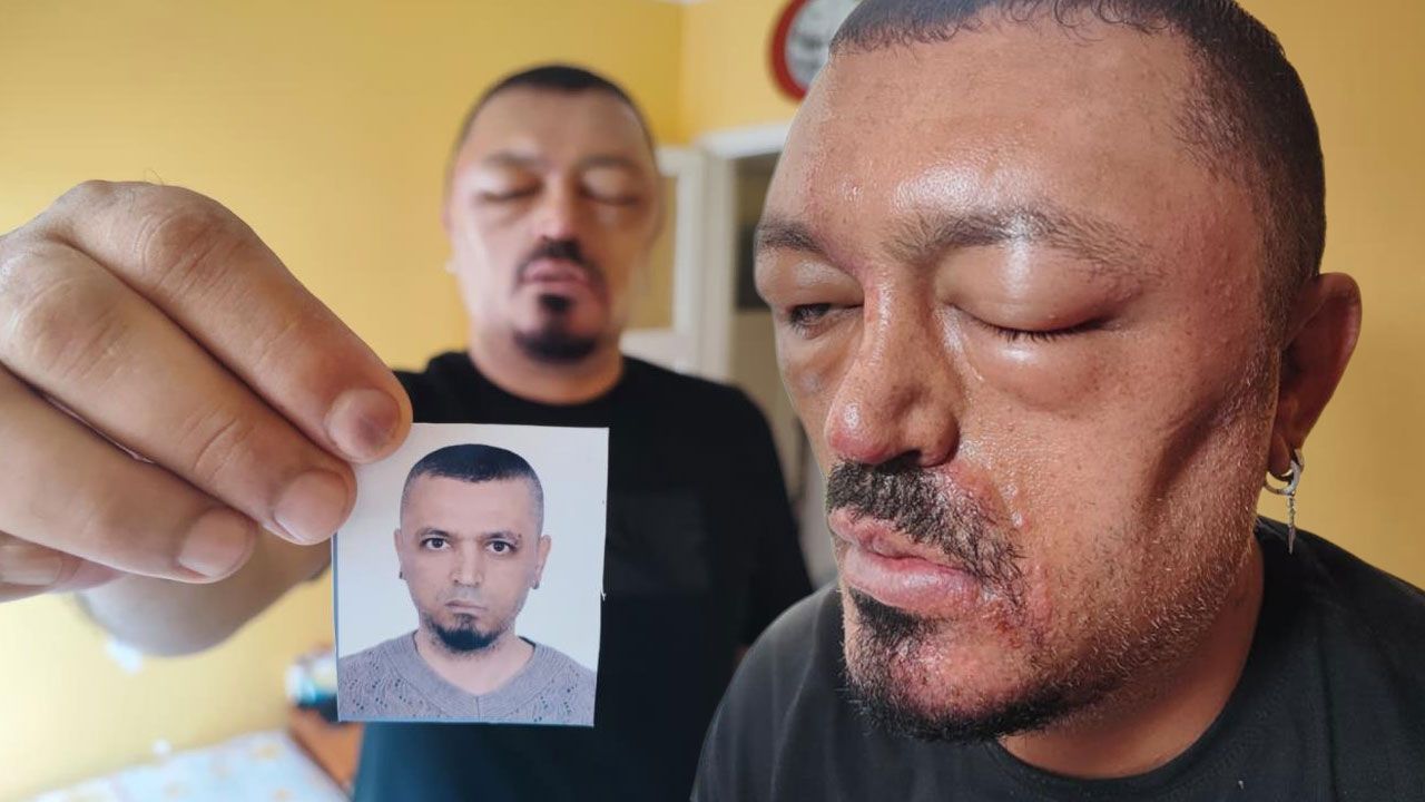 İnternetten aldığı şampuan hayatını kararttı! “Gözlerimi kaybedeceğim diye korktum”