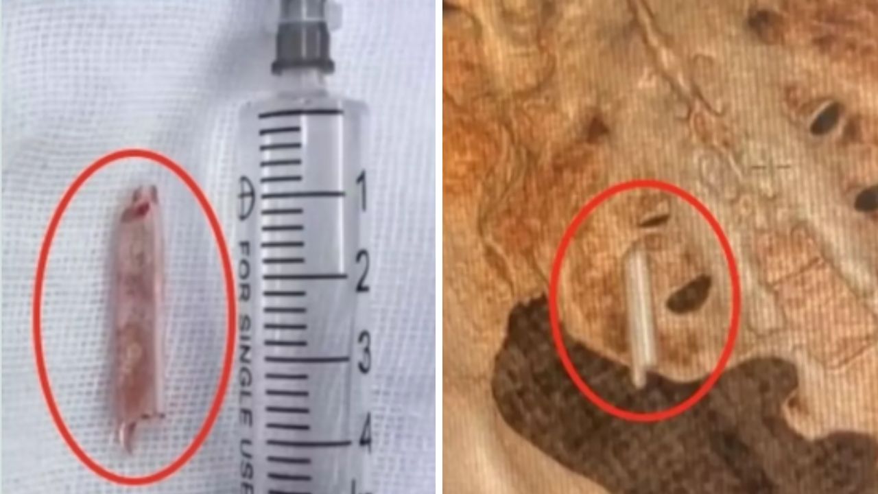 Duyanlar kulaklarına inanamıyor! 22 yıl boyunca kalçasında termometreyle yaşadı