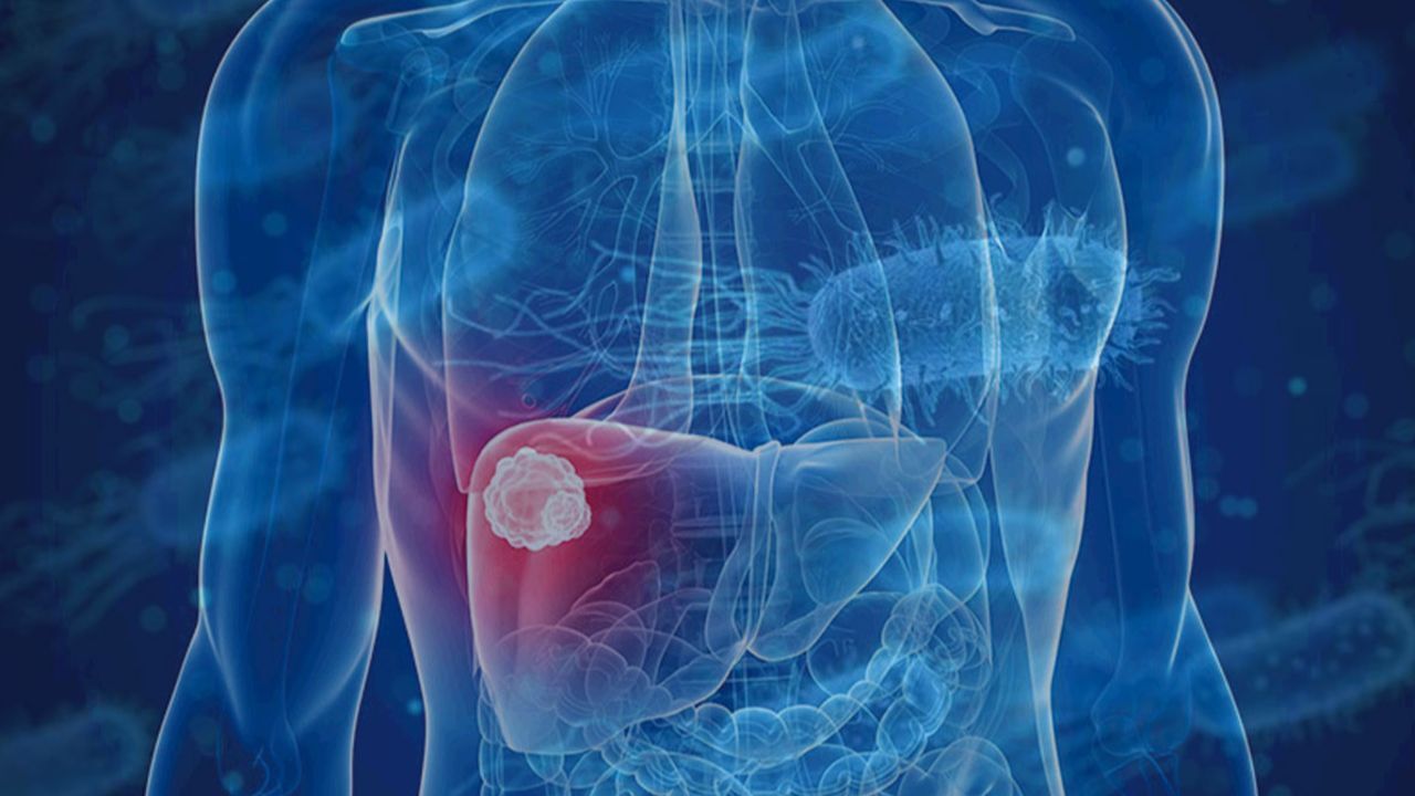 Ölümcül karaciğer kanserinde tedavi umudu: Bilim insanlarından çığır açacak buluş
