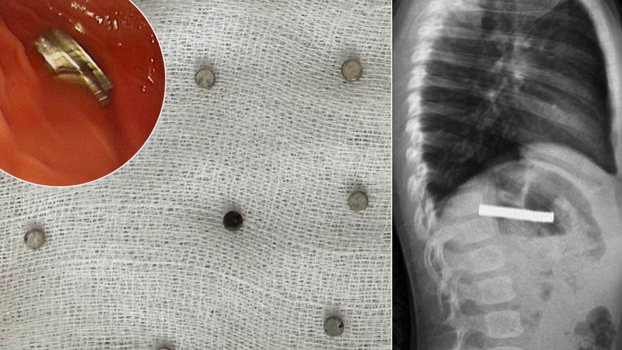 Kimse nasıl olduğunu anlamadı! Küçük çocuğun boğazından 19 mıknatıs çıktı