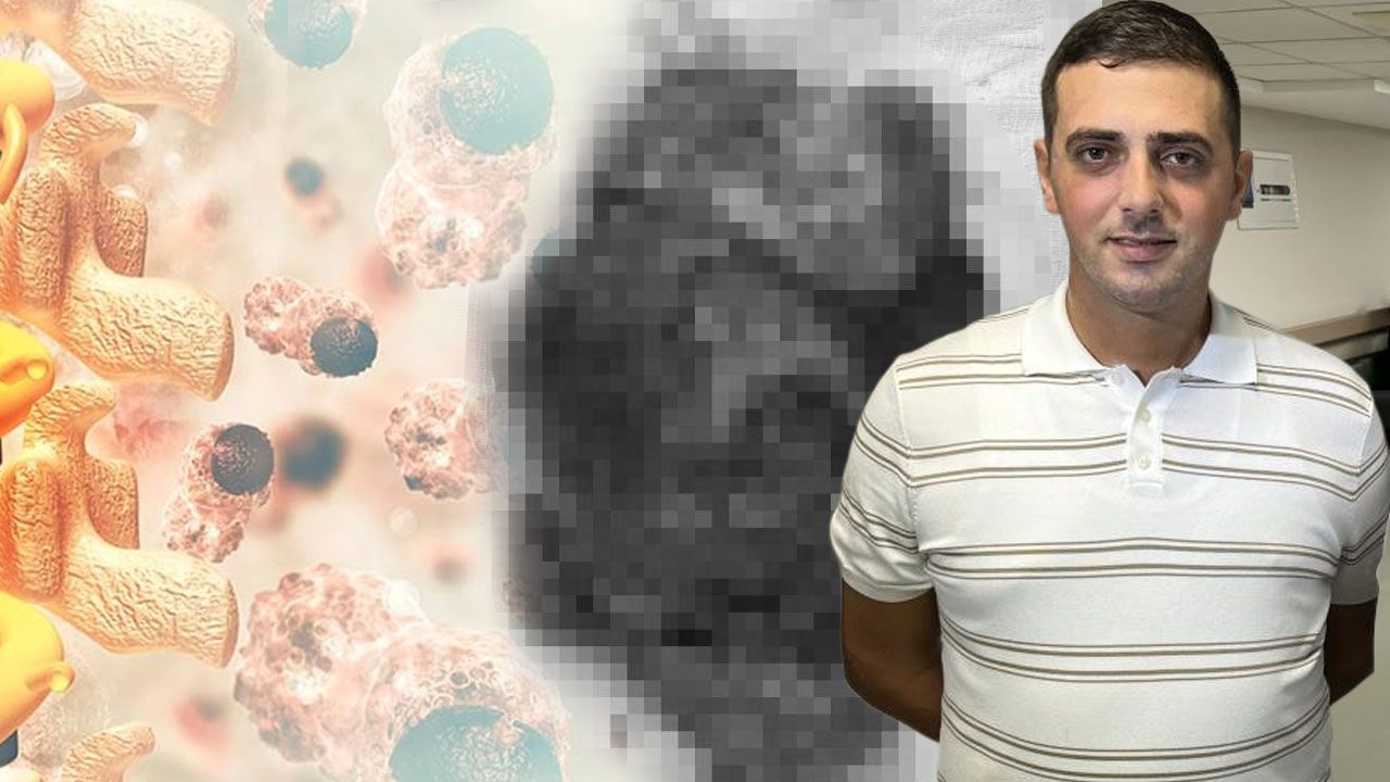 2,5 milyonda bir görülüyor… Geçmeyen kuru öksürüğünün nedeni meğer dev tümörmüş