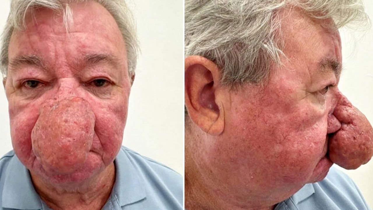 Burnu ağzını kapatacak kadar büyüdü, yemek yiyemedi… Verdiği karar hayatını değiştirdi