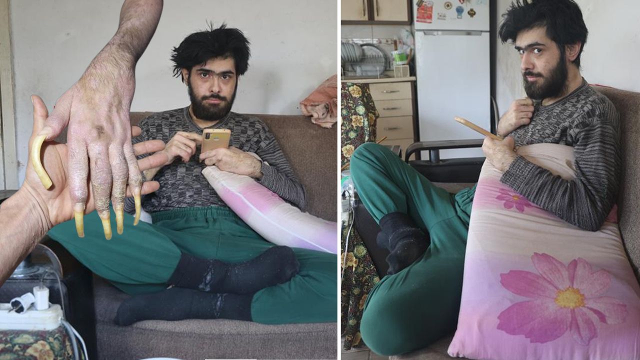 6 Şubat depremi hayatını kararttı! 3 yıldır evden çıkmıyor, banyo yapmıyor, tırnak kesmiyor...