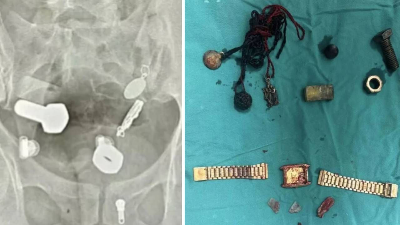 Karın ağrısı şikayetiyle gitmişti, midesinden öyle şeyler çıktı ki... Doktorlar bile şaşkına döndü