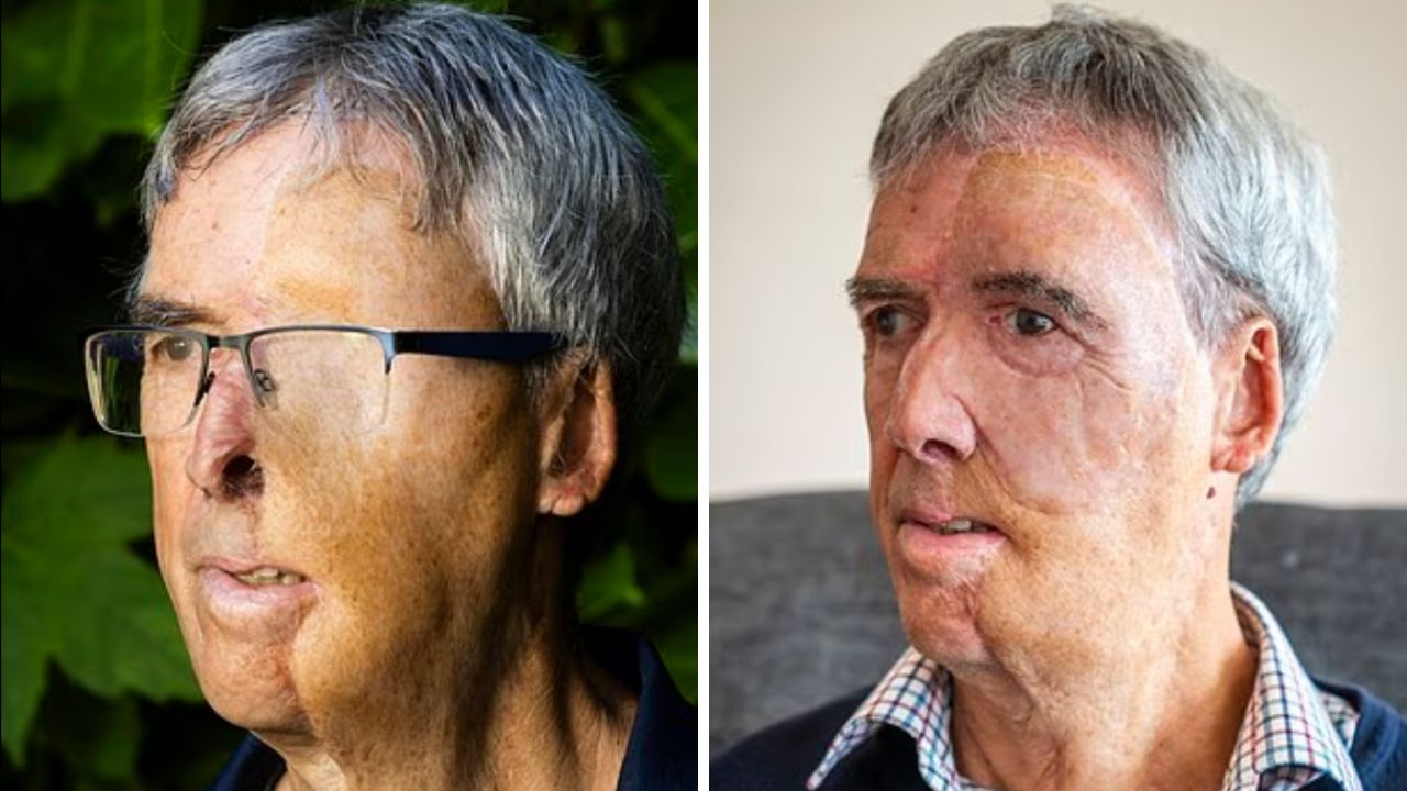 Kazada yüzünün yarısını kaybetmişti! 3D yazıcıyla yeniden yapıldı