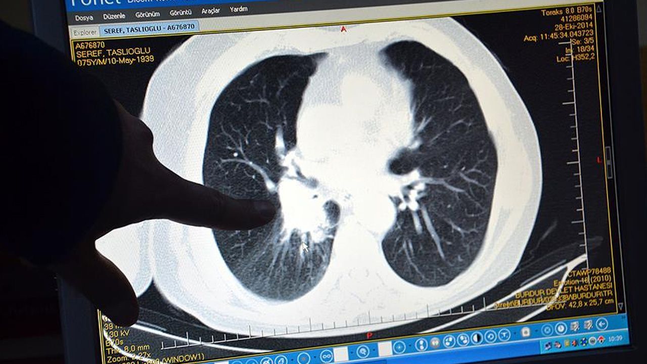 Akciğer kanserinde radyoterapi sonucunu etkileyen 12 gen bulundu