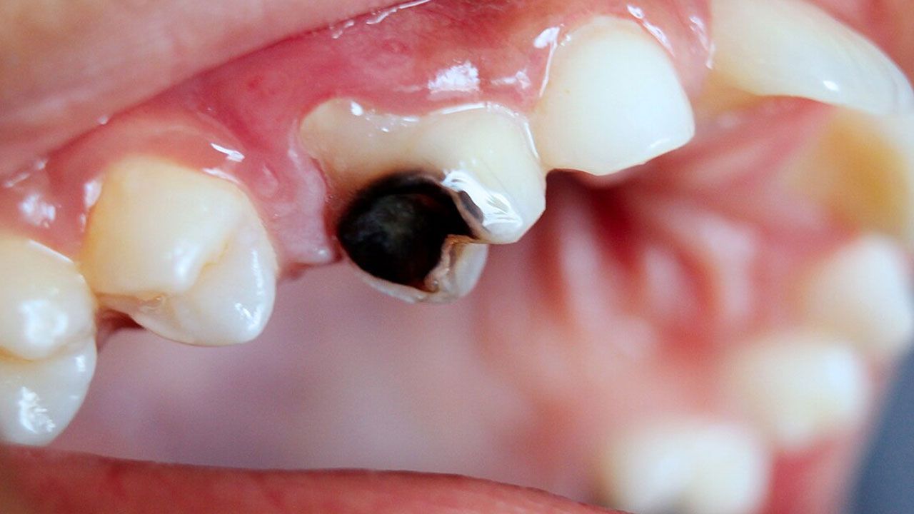 Ağız sağlığında devrim: Çürük dişi onaran jel geliştirildi