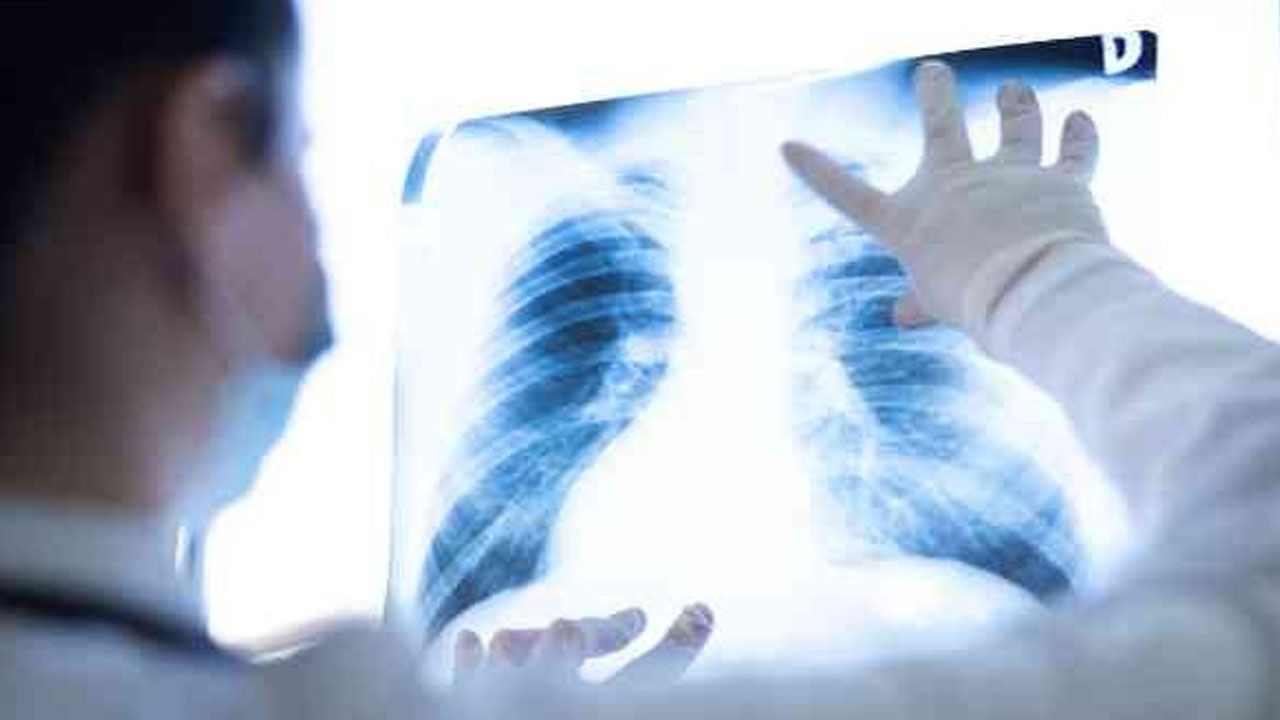 Belirti vermiyor ama ölümcül… Akciğer kanserinde erken tanı önemli
