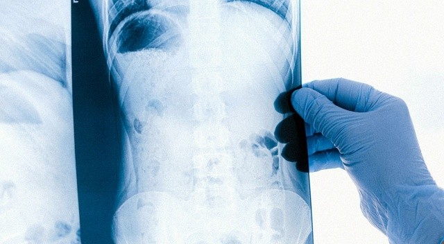 Covid-19 hastalığı hafif geçirenlerde bile organlarda hasara neden oluyor görseli