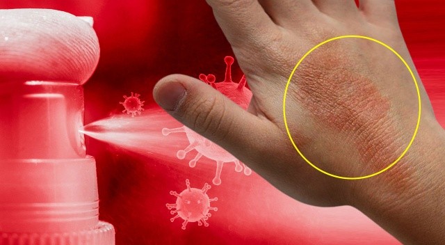 Dezenfektan ve kolonya kullanımı el egzamasına davetiye çıkarıyor görseli