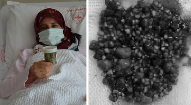 Safra kesesinden 553 tane taş çıkarıldı: Kuş gibi hafiflemiş hissediyorum görseli