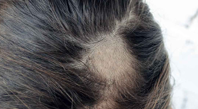Oscar törenindeki tarihi tokadın ardındaki hastalık:  Alopesi areata görseli